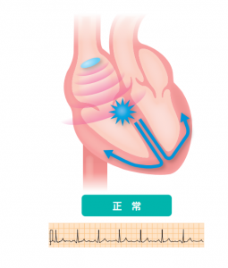 心房細動での心臓の収縮模式図