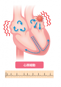 心房細動による心臓の異常な興奮