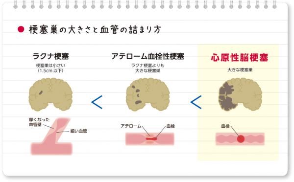 梗塞巣の種類と血管の詰まり方(ラクナ梗塞・心原性脳梗塞など)