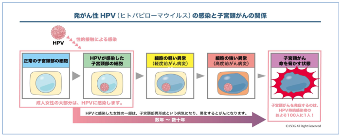 HPV感染から子宮頸がんに進行する過程の図解